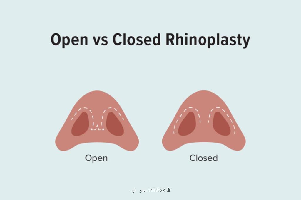 مقایسه روش های جراحی بینی روش های باز و بسته