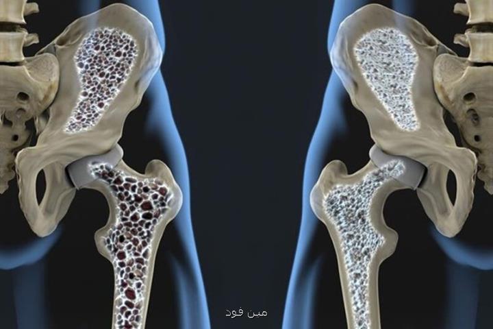 کمبود این ویتامین سبب پوکی استخوان می شود