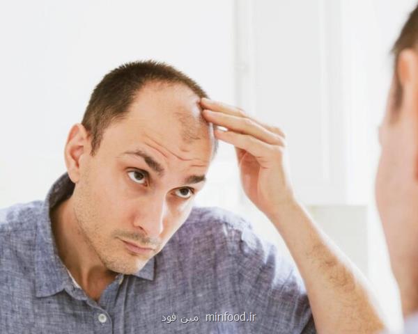 چند باور نادرست در رابطه با ریزش مو