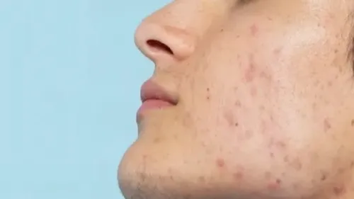 قوی ترین نسخه طب سنتی برای مواجهه با آکنه صورت به علاوه فیلم