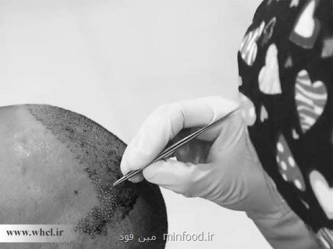 چند توصیه قبل از اقدام برای كاشت مو