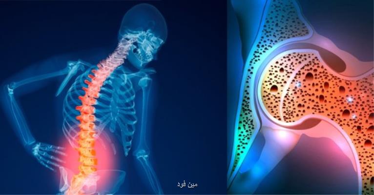 ناآگاهی مردم از ابتلاء به پوكی استخوان