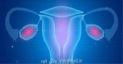 همه چیز درباره سندروم تخمدان پلی كیستیك